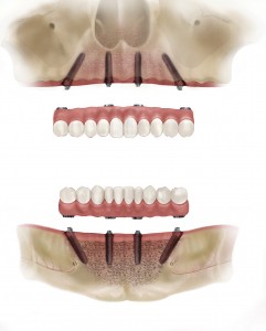 full arch implants teeth on 4