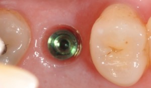 close up of dental implant