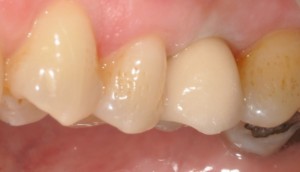 the final result, implant dental crown fitted in place