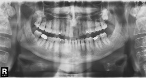 Why Treatment Planning is Important for Dental Implants