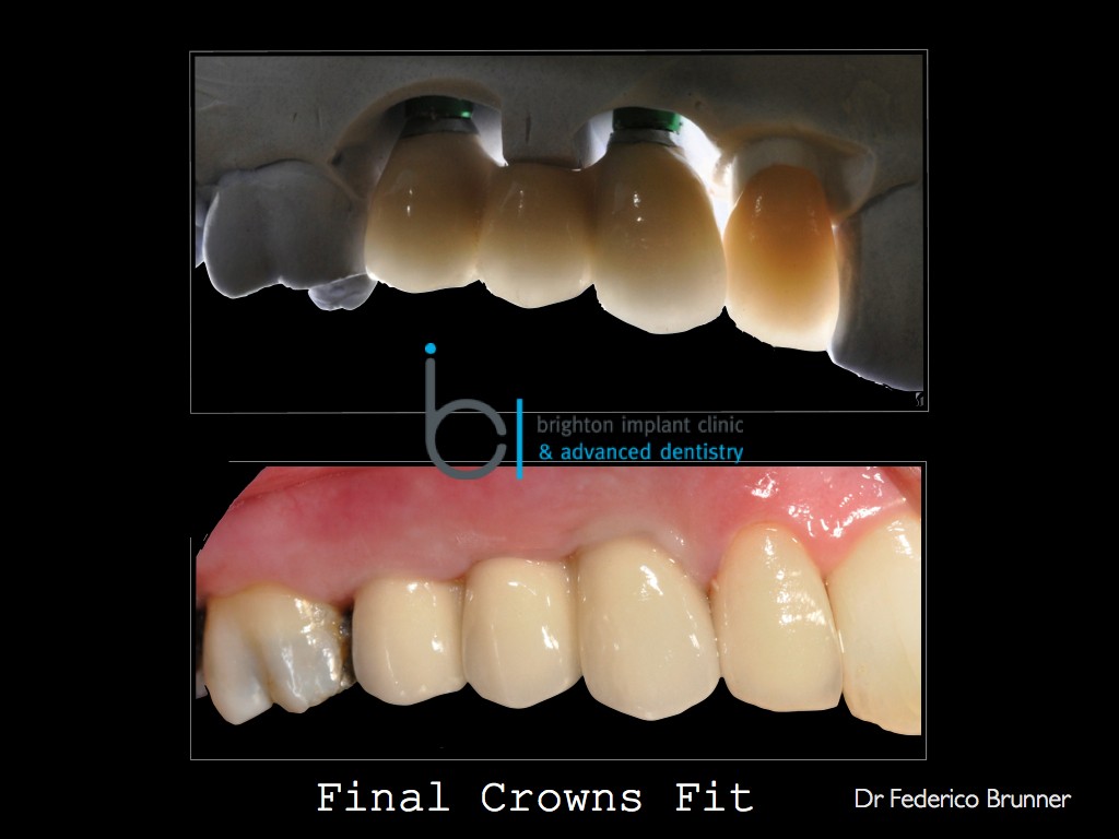 Final result showing a 3 unit bridge on implants plus full ceramic crown on upper right lateral incisor