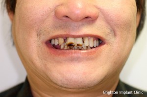 Dental implants help smokers get teeth back