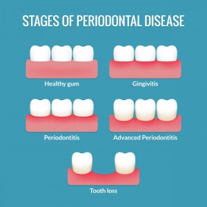 gum disease Chart
