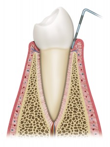 gum disease probing periodontal pocket