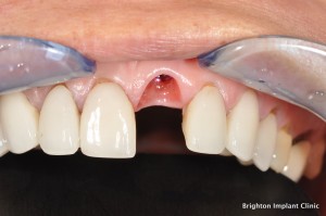Dental Implant Treatment Using a provisional crown