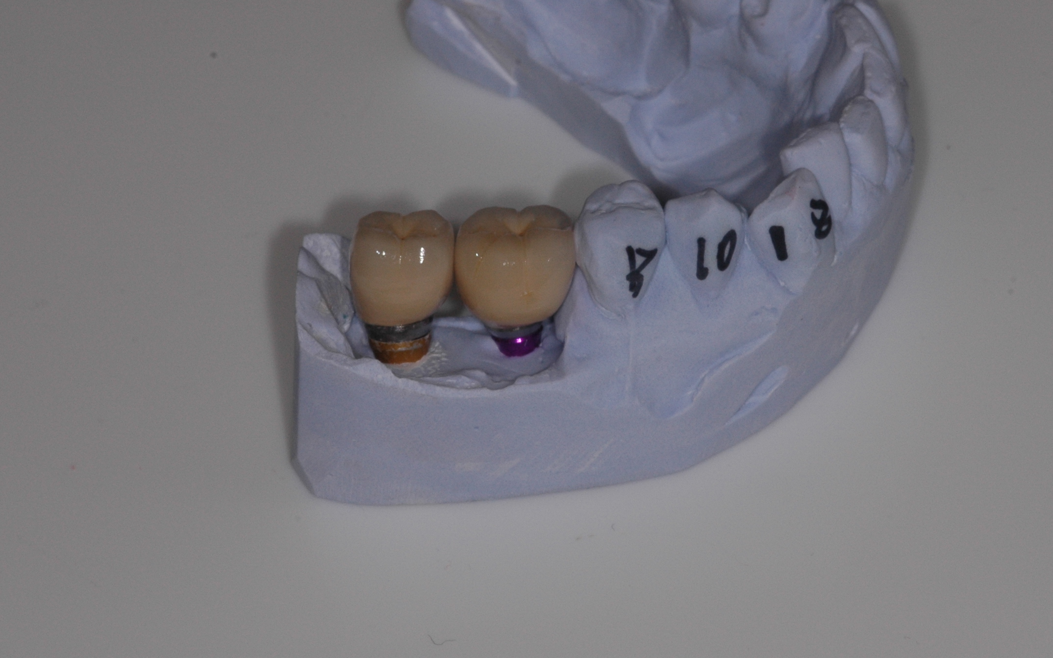two missing molar teeth replaced with dental implants