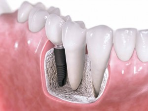 Why Choose Dental Implants?