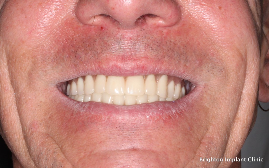 Upper and lower teeth-on-4