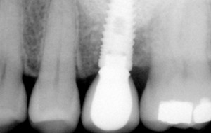 dental implant placed with sinus lift by a cosmetic dentist