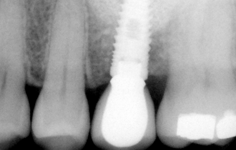 dental implant placed with sinus lift