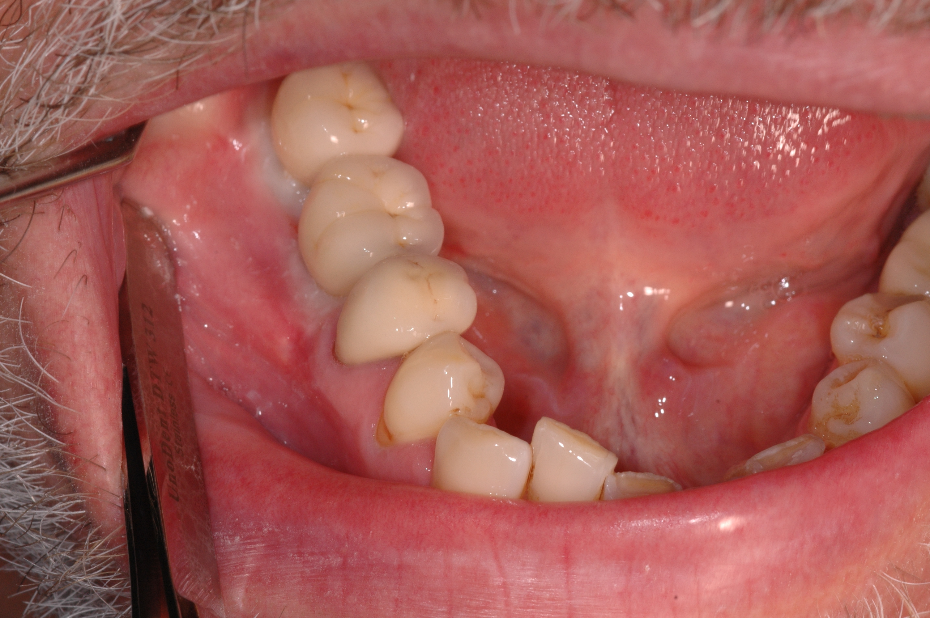 Cement retained crowns in the mouth