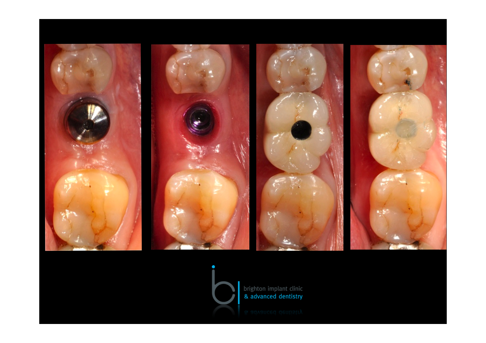 Implants In Dentistry photographs
