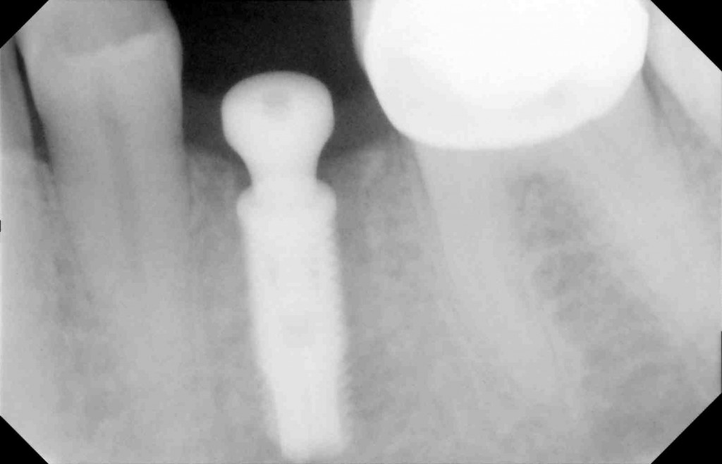Dental implant placed into bone