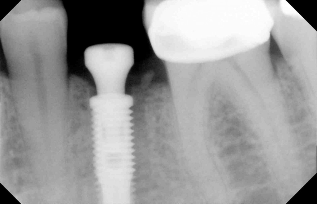 A single tooth dental implant during the healing phase