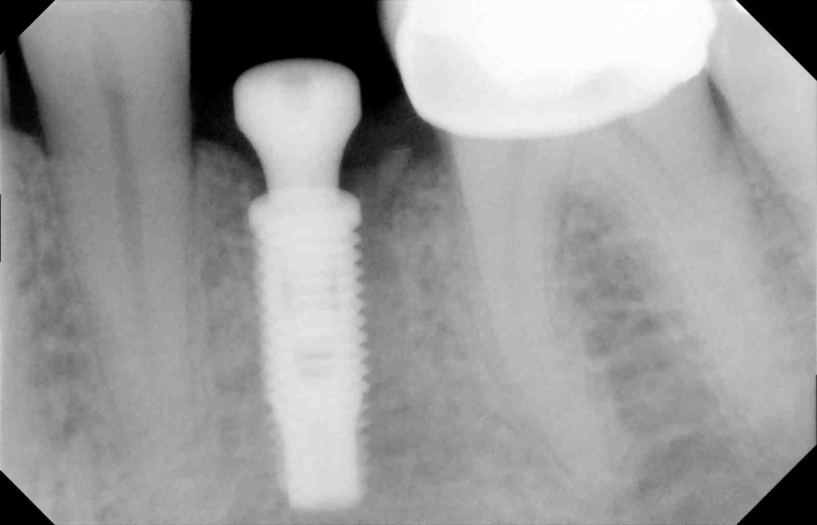 dental implant in place during healing phase