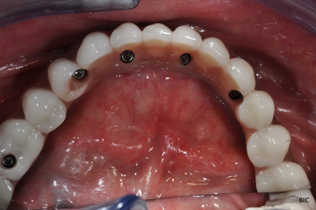 Full arch fixed bridge on dental implants