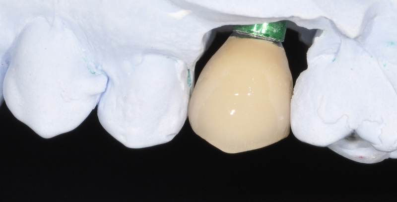 Dental implant with porcelain crown