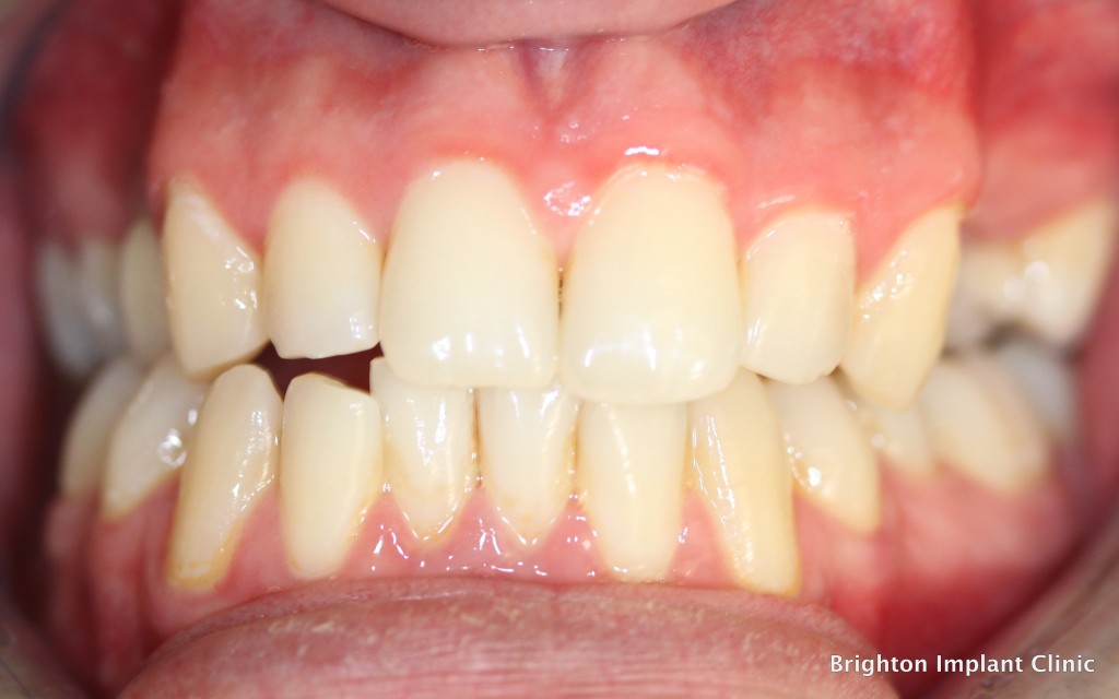 Before photo of dental implants case - Dental implants can replace missing teeth