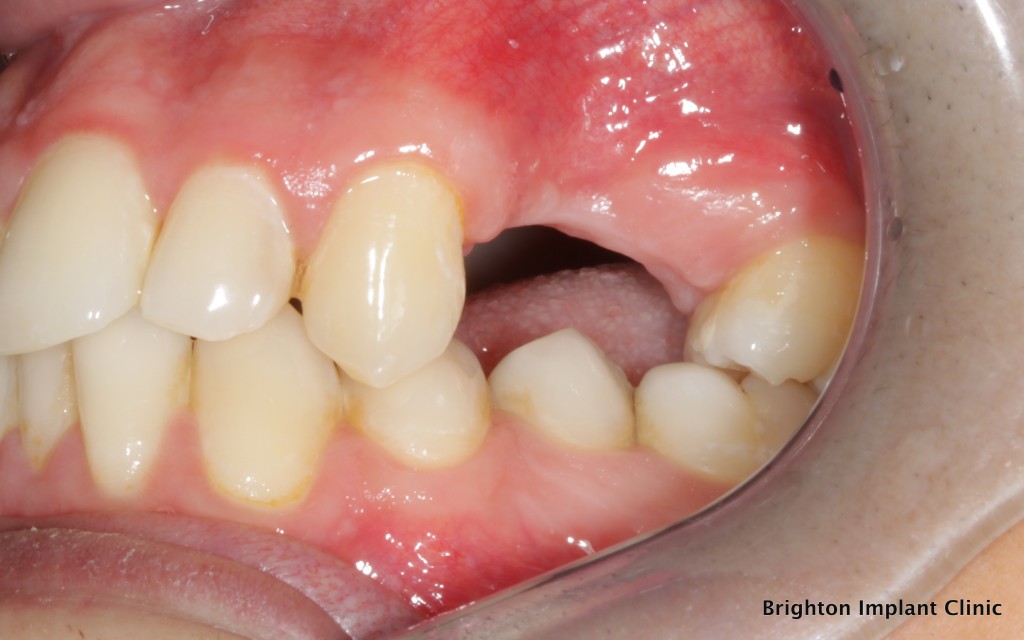 The Science of Implant Dentistry - 2 upper left premolars are missing, dental implants can replace missing teeth