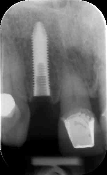 Are dental implants safe, this dental implant was placed under local anaesthetic