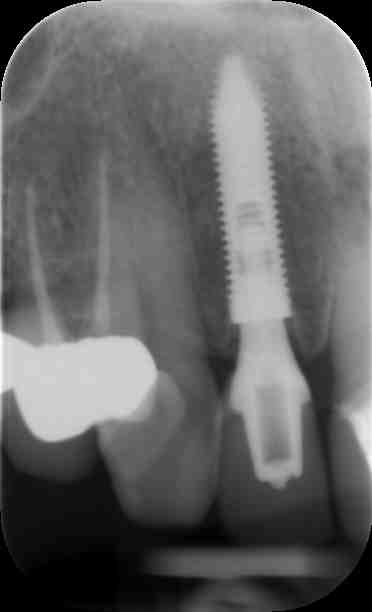 Dental implant restored with provisional crown