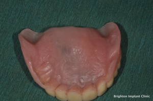 Upper full denture