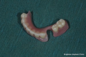 lower removable dentures
