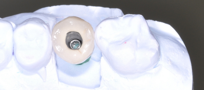 Dental implants on the NHS