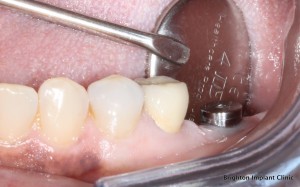 Teeth Implants Prices