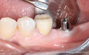 Teeth Implants Prices are affordable at brighton implant clinic
