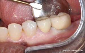 Dentist Implant Cost