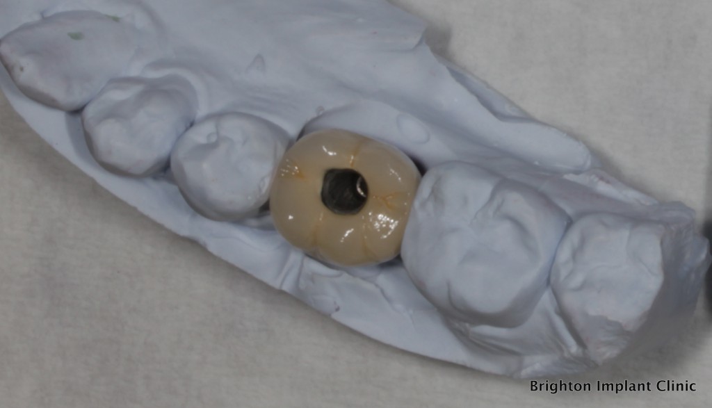 screw retained dental implant crown on plaster model before fitting into patients mouth