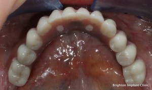 Lower fixed bridge on dental implants