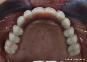 Upper full bridge supported on 4 dental implants (Teeth-on-4)