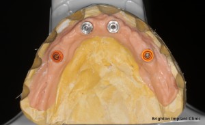 Position of dental implants on working models