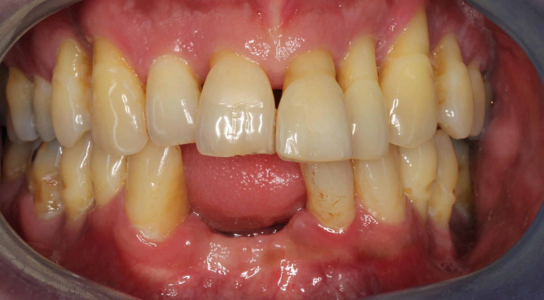 patient presented with tooth caused by sinus infection anterior aspect