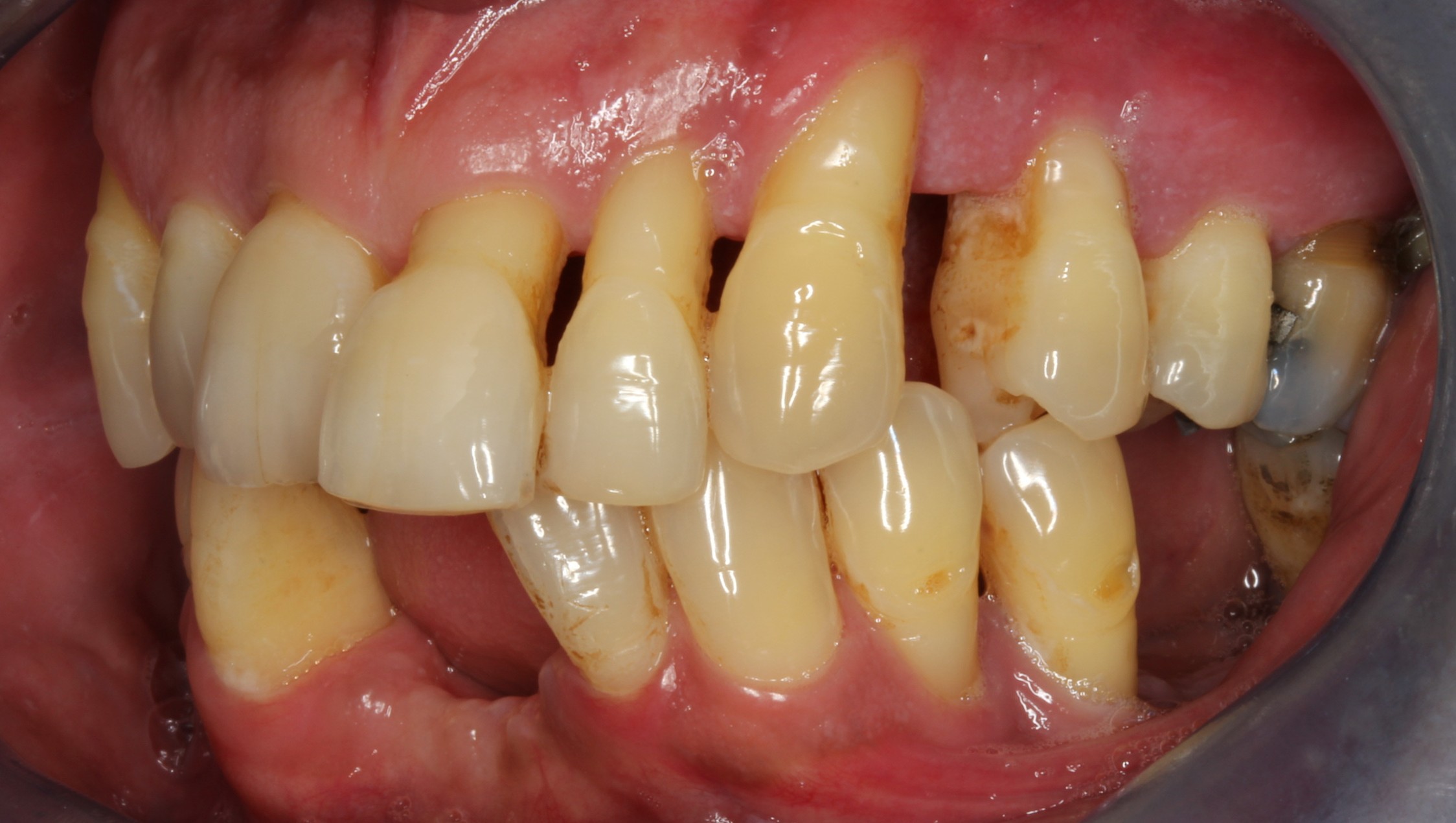 patient presented with tooth caused by sinus infection left aspect