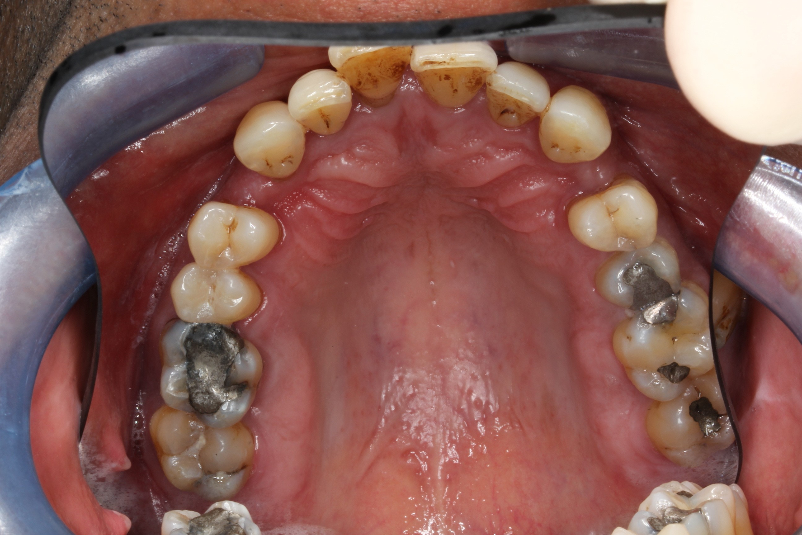 patient presented with tooth caused by sinus infection upper arch
