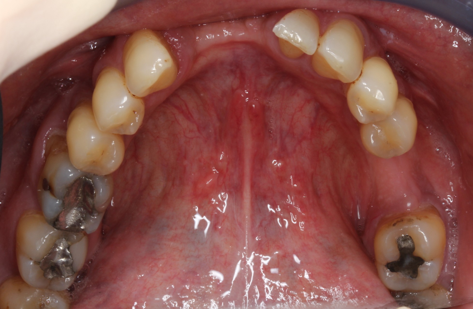 patient presented with tooth caused by sinus infection lower arch