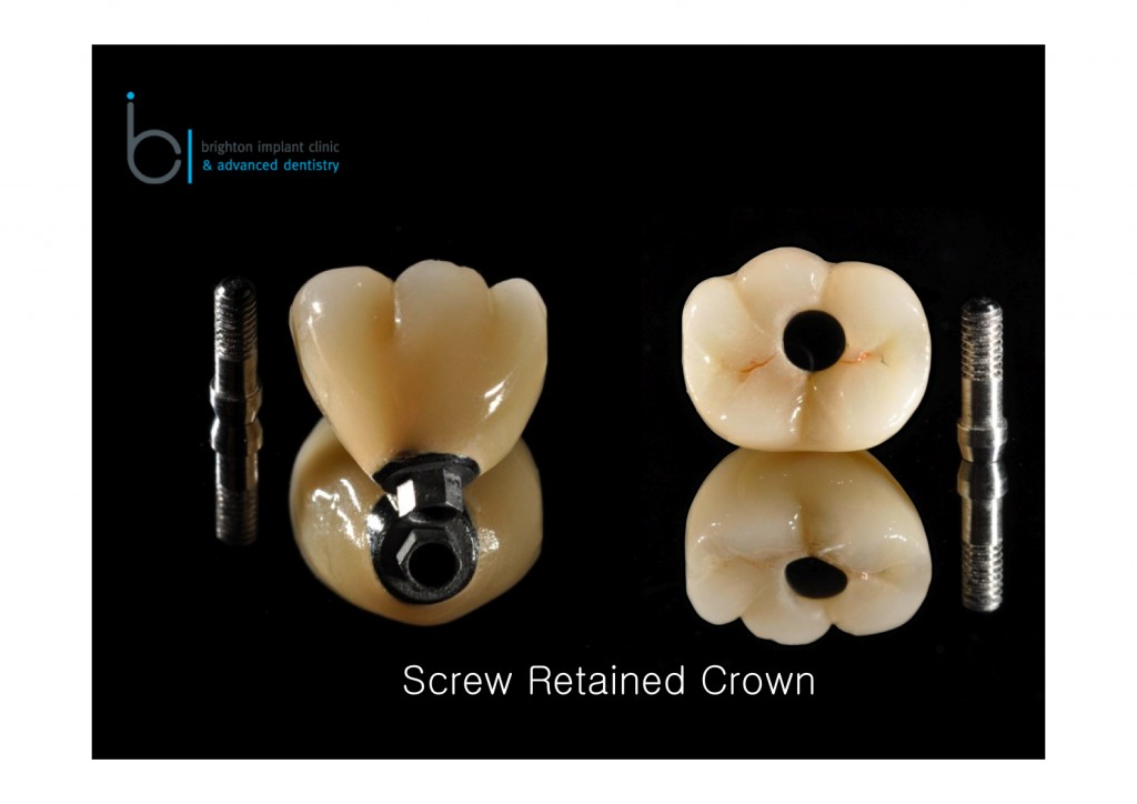 screw 1 st molar retained copia1