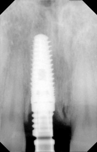 dental implantology showing implant fixture in place