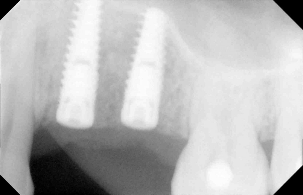 two dental implants integrated with bone