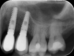 Dentists Implants Completed