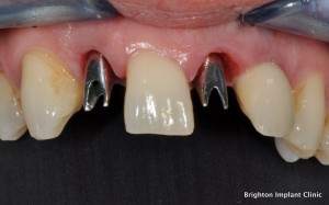 Dental Implant Teeth