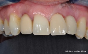 dental implant teeth cemented