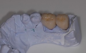 Dental Implant Design in dental implant technology
