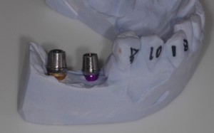 titanium abutments in Dental Implant Technology
