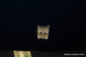 Dental Implant Pricing provisional acrylic bridge
