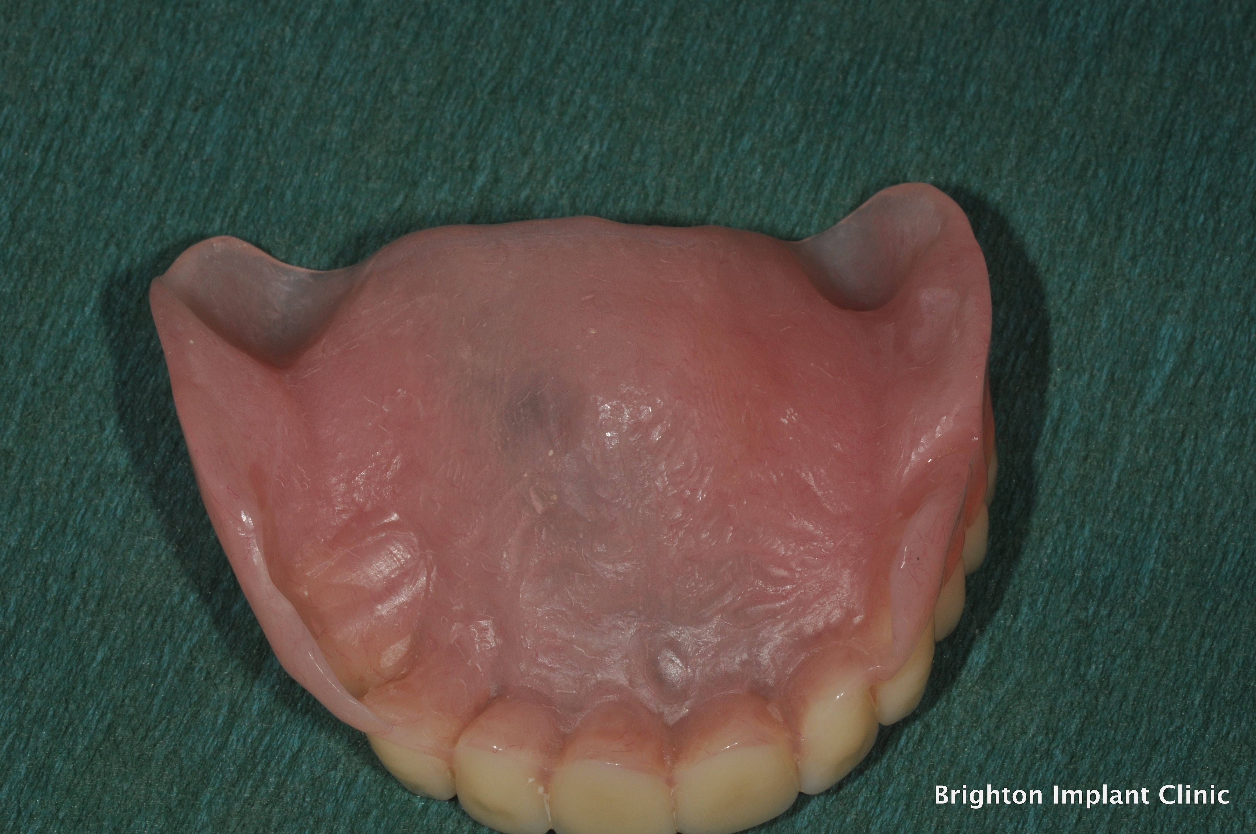 dental implant denture are better than conventional removable dentures