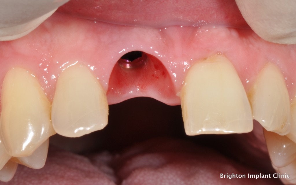 dental implantology showing a dental implant placed to replace a missing upper right central incisor